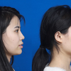 鼻综合修复|一眼假鼻子与华丽混血鼻之间到底差在哪里