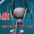 尿频、尿急、尿不尽-前列腺增生【3D展示】