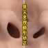 3D动画演示：鼻尖夹捏畸形矫正。