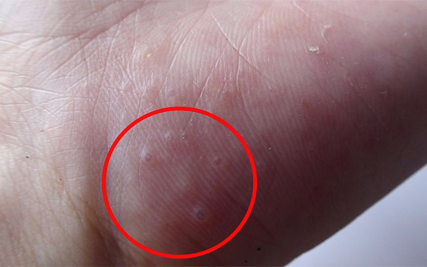 手上长这种小水泡,到底是怎么回事?