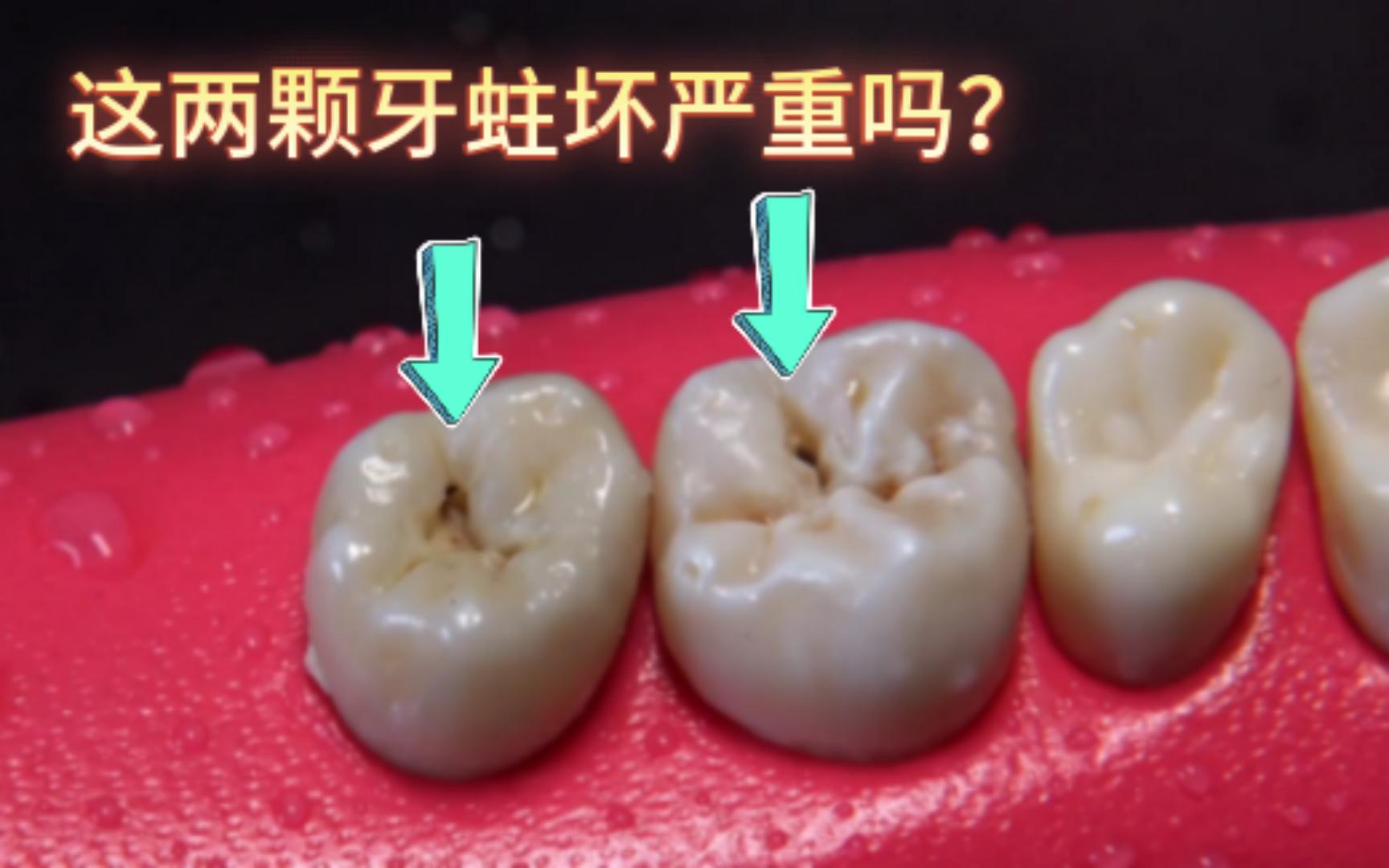 这两颗牙蛀坏严重吗？