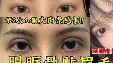 眉眼被割得特别近都眉眶骨贴眉毛了，<em class="keyword">双眼皮</em>大肉条假！可以<em class="keyword">修复宽</em>降窄，拉开眉眼距吗？