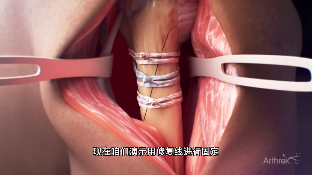 肱骨骨折的手术过程，3D演示。。