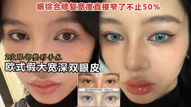 2次眼整形手术，欧式假大宽深<em class="keyword">双眼皮</em>，眼综合<em class="keyword">修复</em>宽度直接窄一半