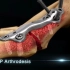 外科手术固定中用到的螺钉和钢板的类型你了解多少呢？