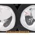 大叶性肺炎CT病例分享，和新冠肺炎有何区别？医生讲解！