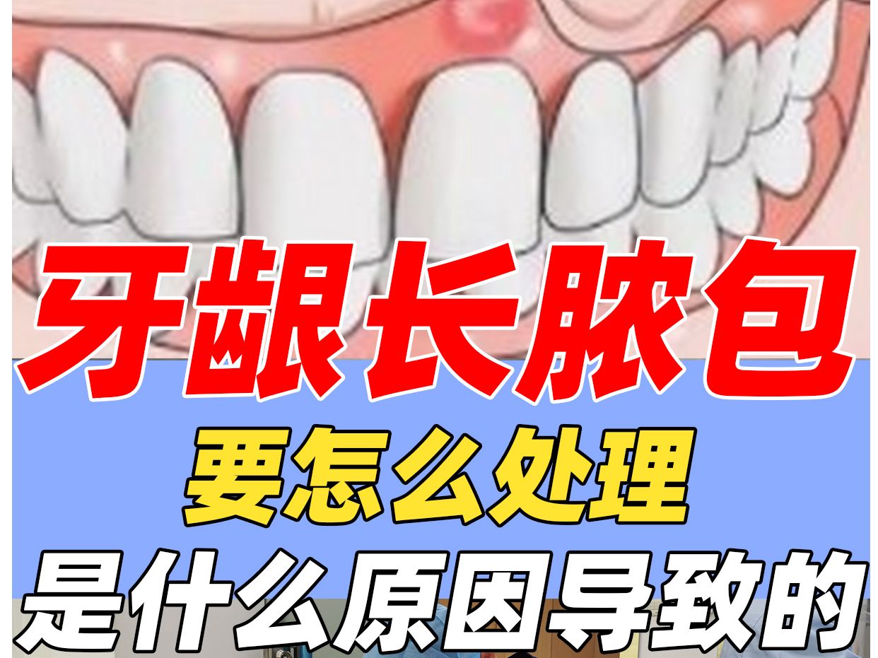 牙龈长脓包是怎么回事，要怎么处理？