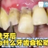 洗牙后为什么牙齿会松动？真的是医生操作的问题吗？
