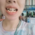 隐形牙套-牙齿状态变化