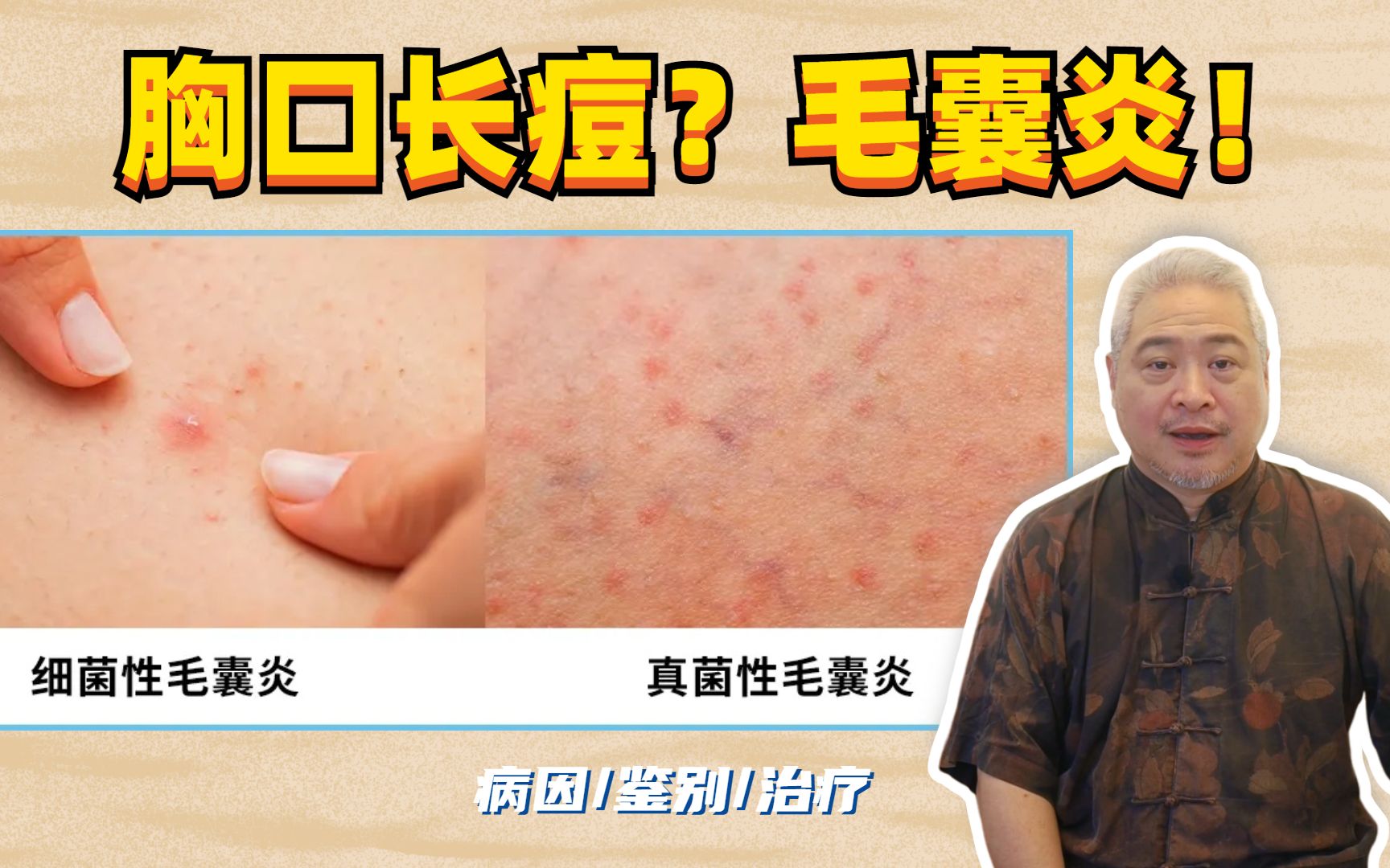 【皮肤科教授】为什么前胸、后背长了痘？怎么治疗？