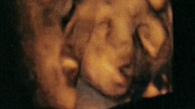 孕期产检四维图像与宝宝出生后的对比，看看像不像