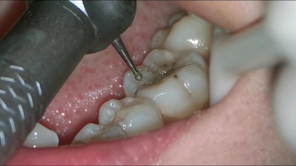 补牙是怎么补的？