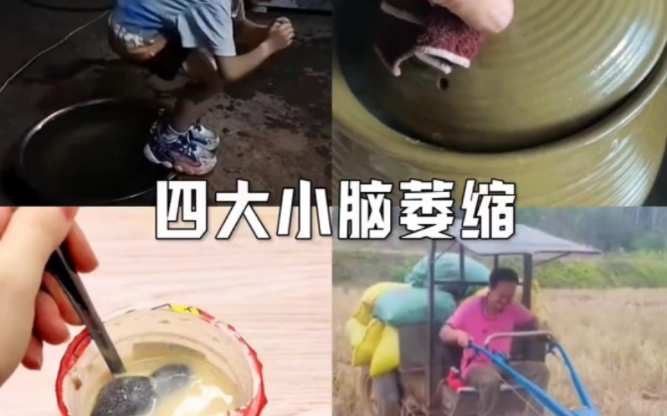 四大小脑萎缩