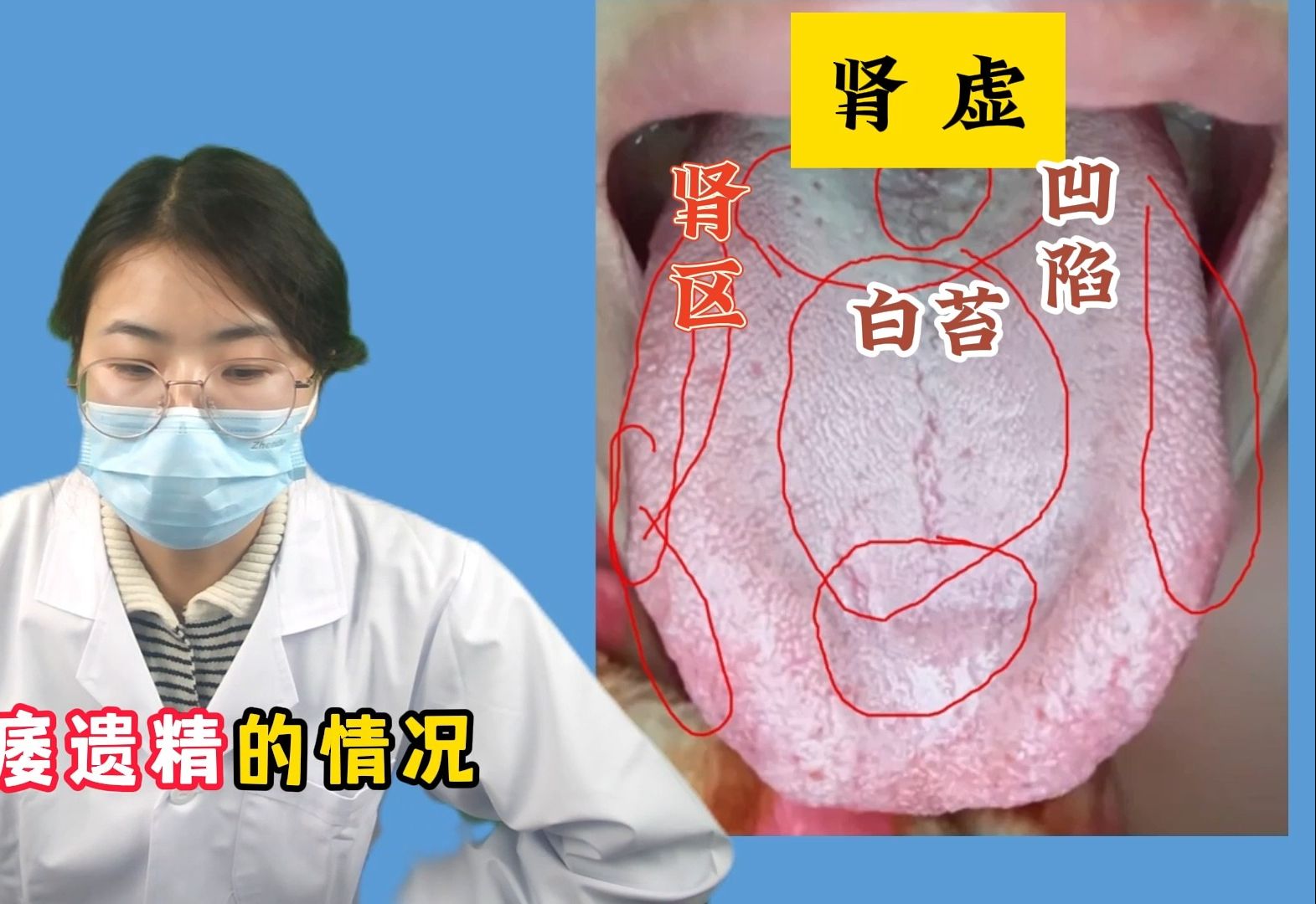 潘大夫舌诊：舌根像铺了一层面粉，并且有条裂纹，肾功能指定弱啊