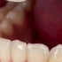 片切叫“邻面去釉”，是非拔牙矫治常用方法之一。牙齿邻面釉质厚度约0.75-1.25mm，日常进食中也存在正常的生理耗损，
