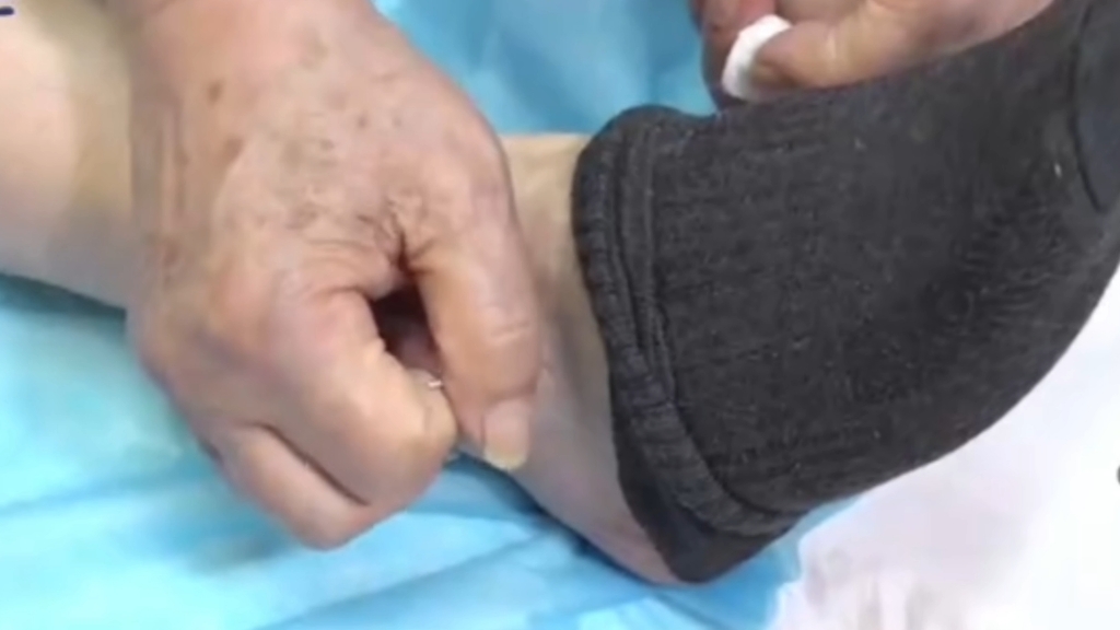 郭老针丘墟穴治脚踝旧伤