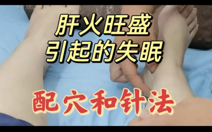 失眠-(肝火旺盛引起的失眠)-配穴和针法)-陈栋