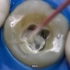 根管治疗戴牙冠全过程