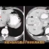 肝脏五叶八段在CT上如何划分的？放射科医生讲解，收藏学习