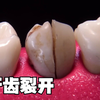 种植牙齿修复全过程，种一颗牙齿真不便宜