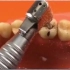 超详细补牙过程，看完就知道为什么有人补牙贵