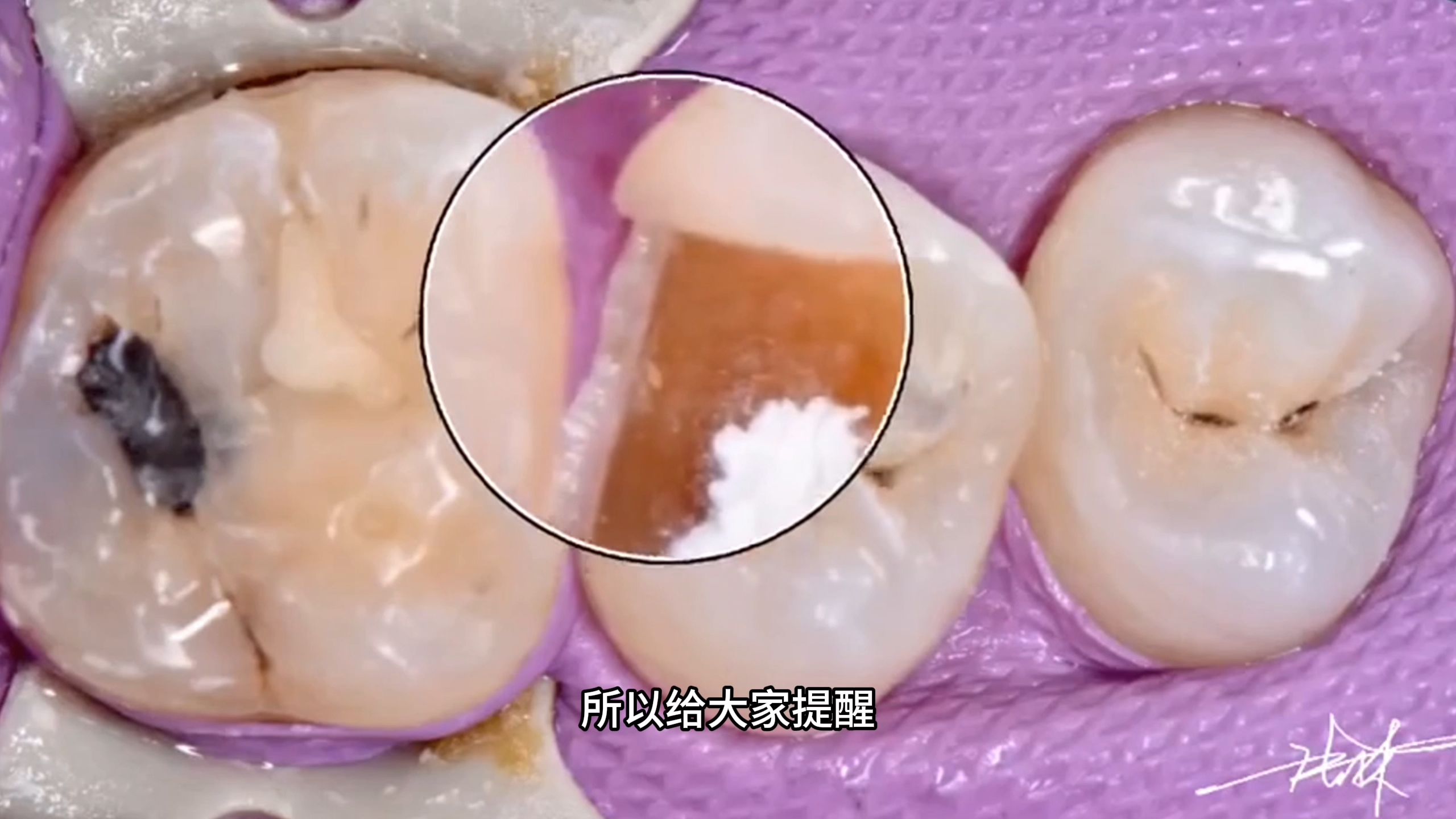 【张林】5天学会做嵌体2——冠延长术