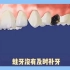 龋齿早点补，严重更受苦。蛀牙就会蔓延的，