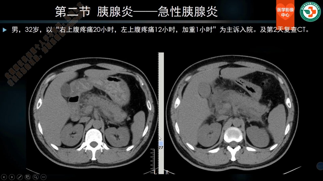 第二十五讲 急性胰腺炎plus01急性胰腺炎（共30讲）