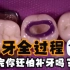 超神技  补牙全过程  看完你还怕补牙吗？