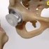 最简单清晰的髋关节置换手术过程，3D演示。。