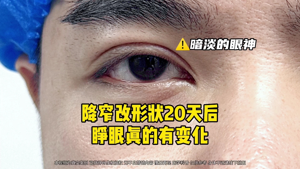 男士双眼皮宽改窄修复20天后，肉眼可见的改变。