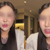 女子为丰臀打400支玻尿酸致臀部感染：里面全是脓水，240万白花了