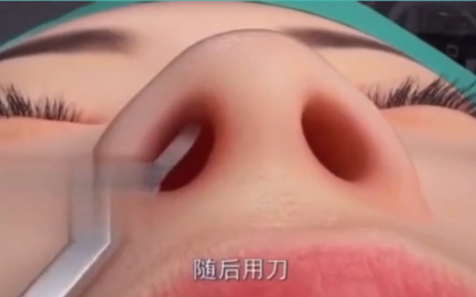 假体隆鼻3D动画全过程