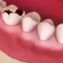后牙蛀了一大块怎么办？该怎么修复才好？