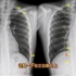 影像解剖：正位胸片上如何数肋骨？放射科医生讲解