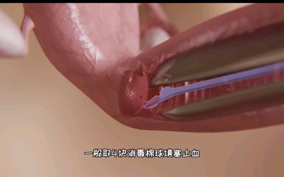 这样也太疼了，宫颈活检手术过程，3D演示。。
