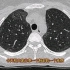 27岁女性，HIV阳性，CT发现肺部多发磨玻璃影，诊断什么？