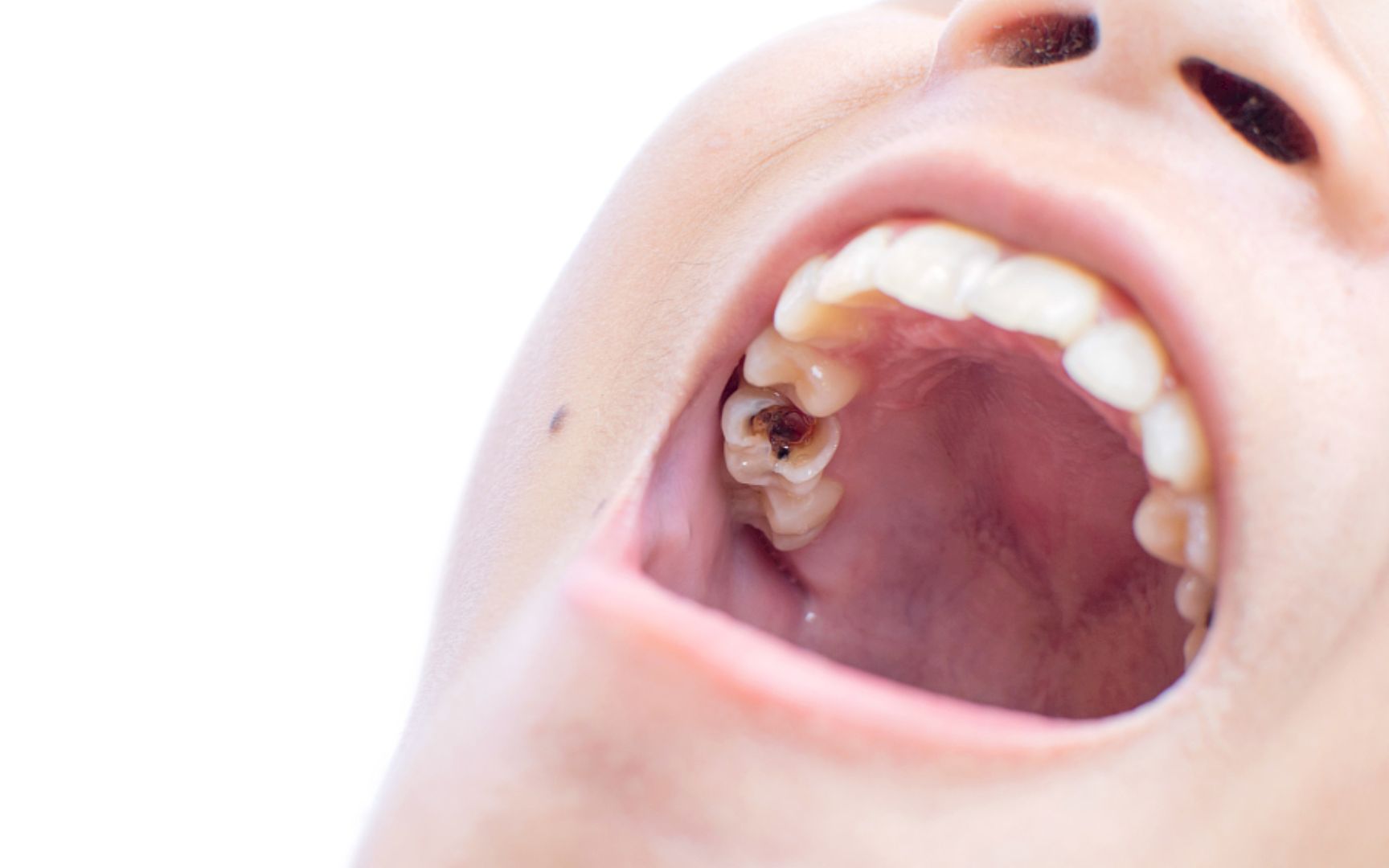 牙齿表面的黑洞是怎么来的呢？这个真相，戳人心窝