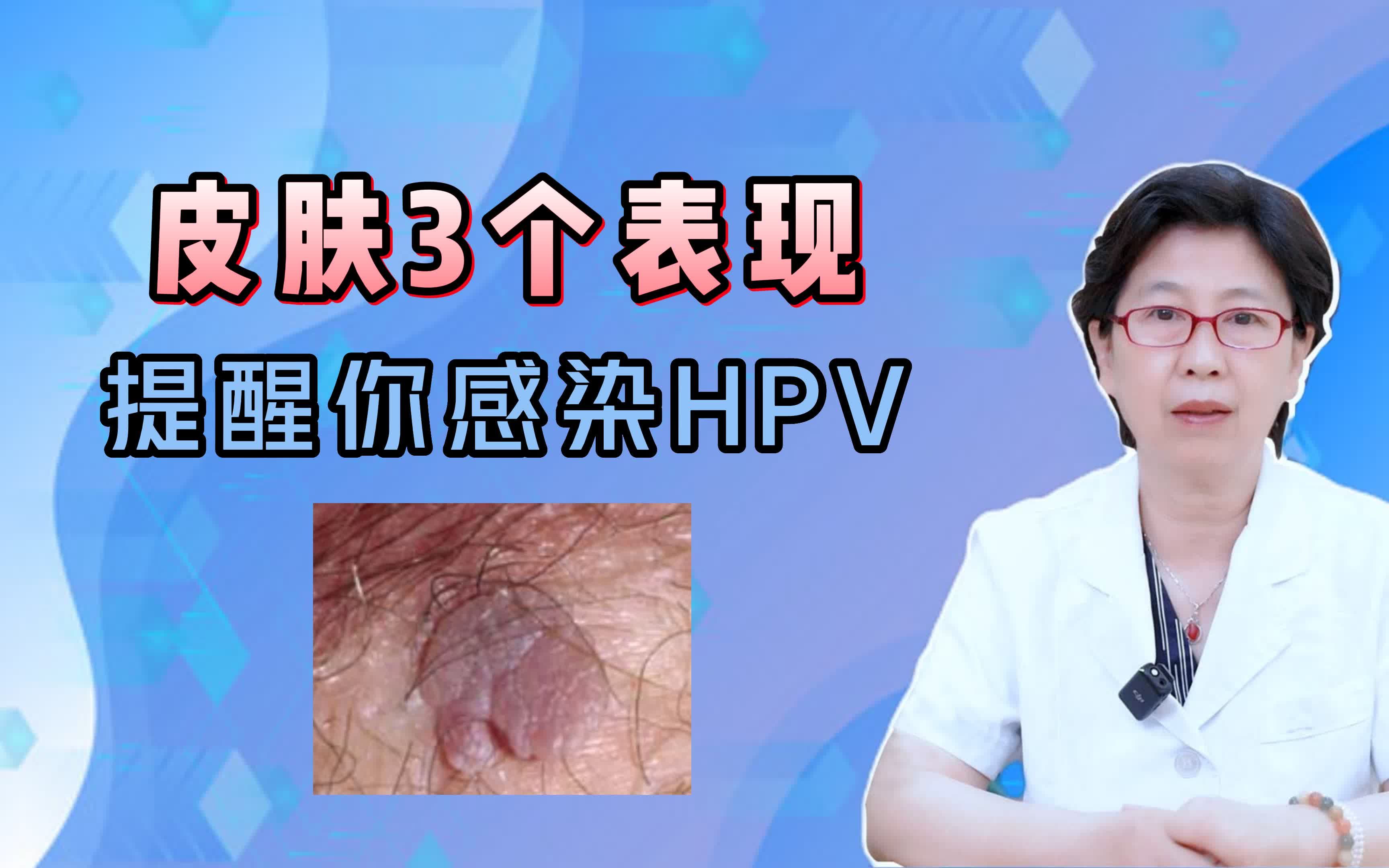 皮肤3个表现， 提醒你感染HPV