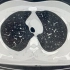 正常胸部ct的肺窗影像