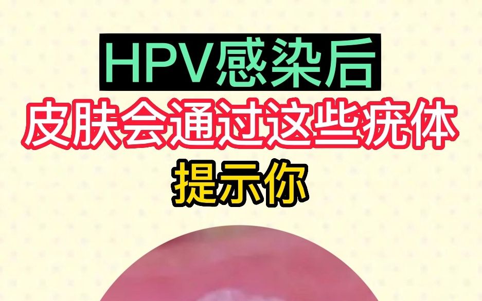 HPV感染后，皮肤会通过这些疣体提示你！