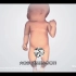 婴儿阴囊鞘膜积液和疝气发生原因和手术过程，3D演示。。