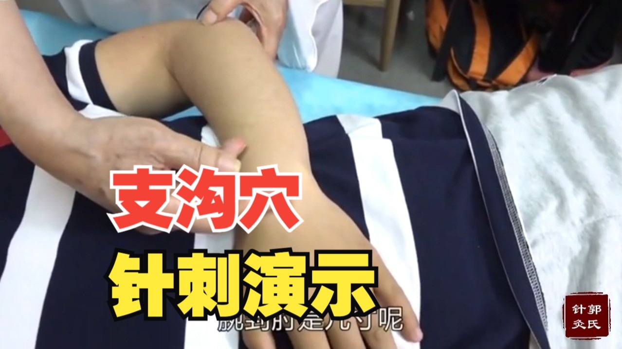 【郭廷英】支沟穴 针刺演示