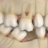 牙齿缺失一颗不种植的影响，年轻人缺牙的越来越多了！