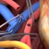 肾移植手术过程，3D演示。。