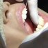 【洗牙】26岁小姐姐去除牙结石！