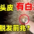 用手抠头皮，指甲里的白泥是什么？会是脱发的征兆吗？