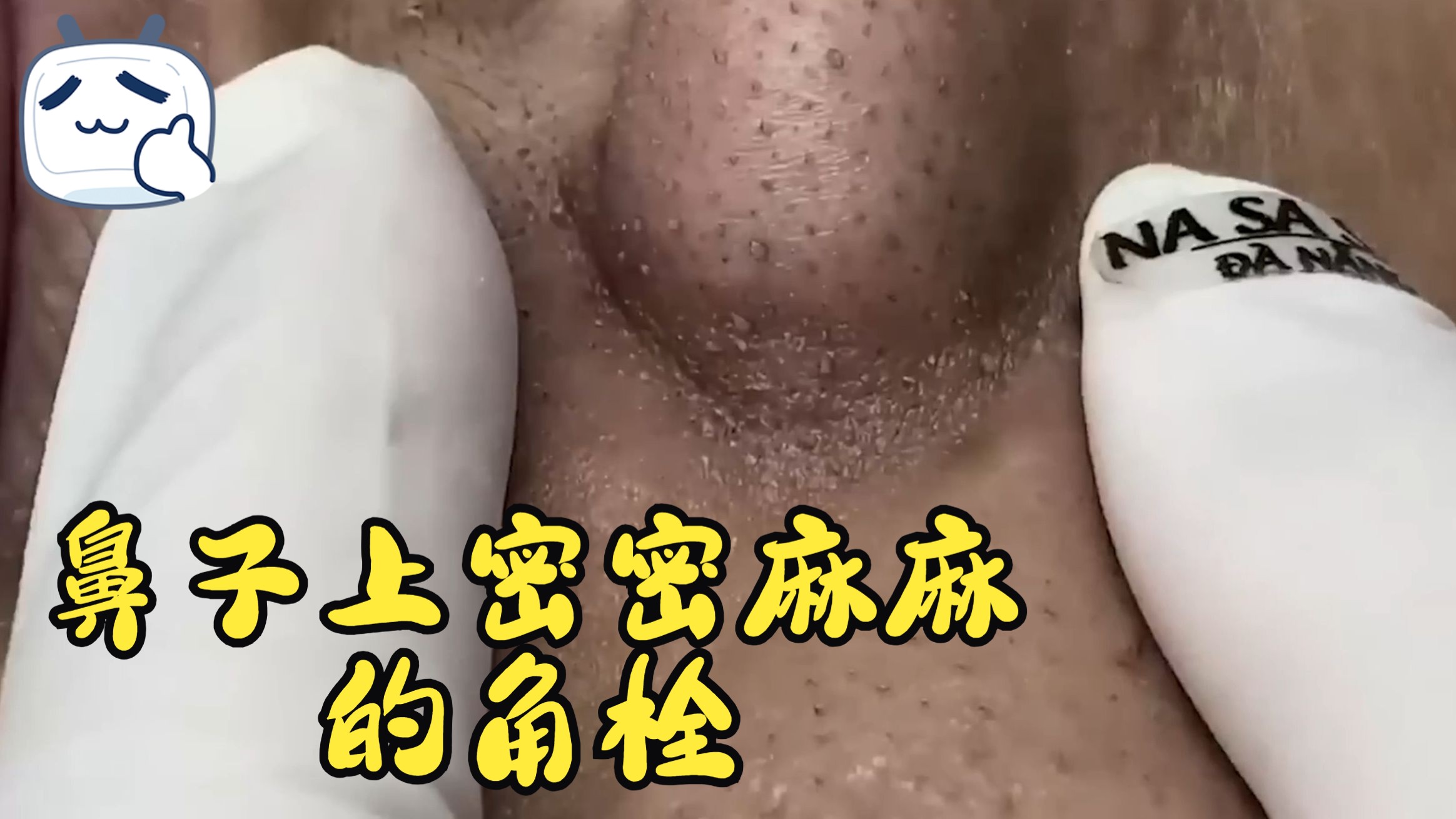 20241207去除鼻子上密密麻麻的角栓