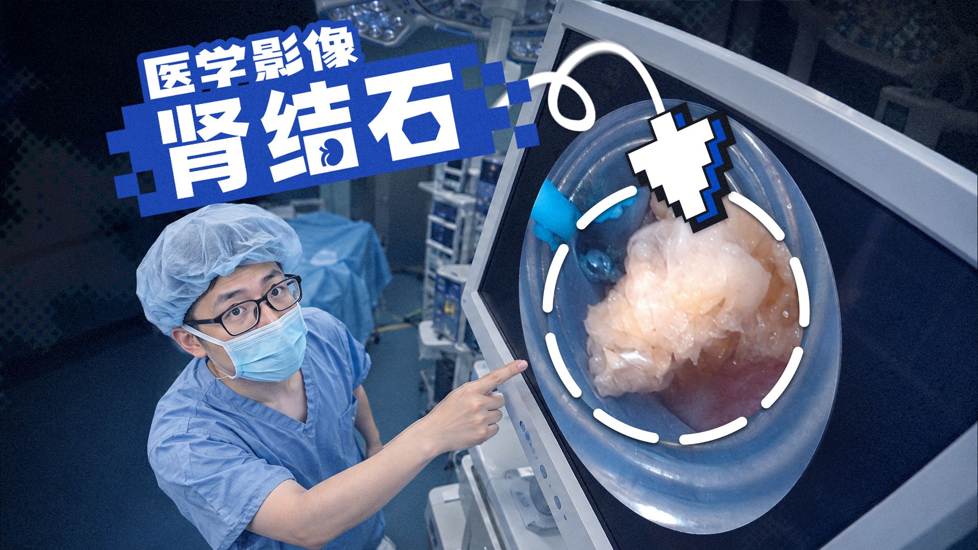 肾里长的石头，医生是怎么取出来的？
