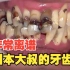 日本大叔的牙齿非常离谱，看牙总共花费6万RMB